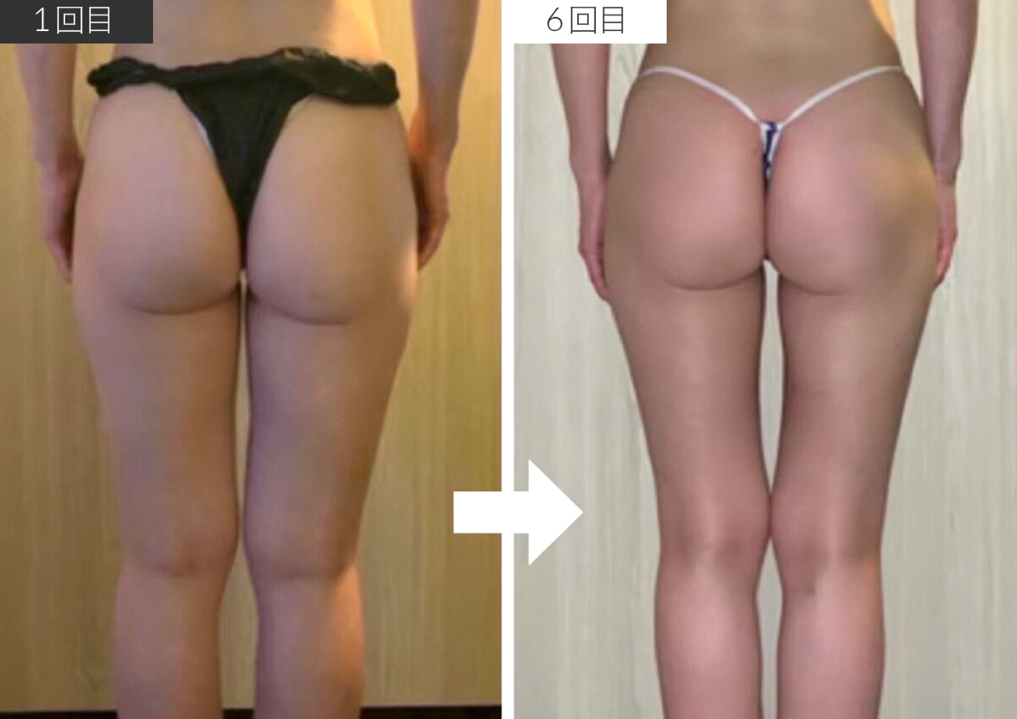 LOWER BODY SCULPTING ビフォアアフター